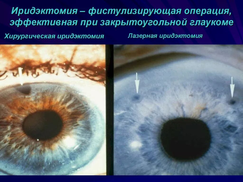 Как выглядит операция на глаза Лазерная коррекция зрения при близорукости методы лазерной коррекции, отзывы и