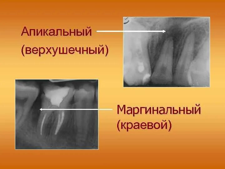 Маргинальный гребень зубы. Маргинальный краевой гребень. Маргинальный гребень зуба анатомия.