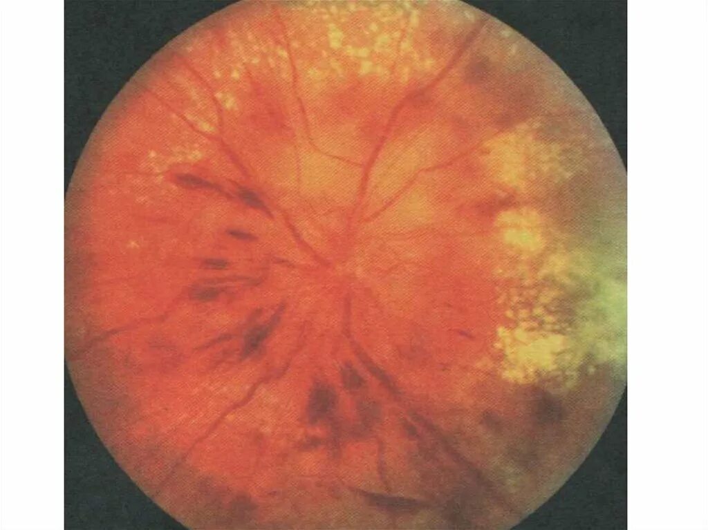 Ретинопатия отслойка сетчатки. Отслойка сетчатки глазное дно. Почечная ретинопатия глазное дно. Диабетическая ангиопатия сетчатки. Изменение на глазном дне