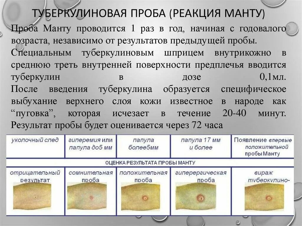 Реакция манту у ребенка 7 лет