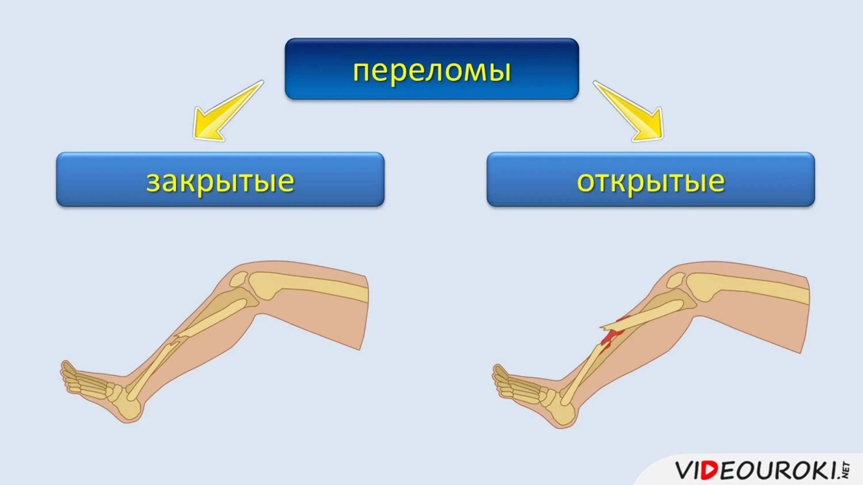 Открытые и закрытые передома. Открытый и закрытый перелом. Открытые и закрытые травмы.