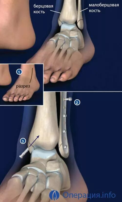 Пронационный перелом лодыжки. Абдукционный перелом лодыжки. Перелом наружной лодыжки слева со смещением. Перелом лодыжки синдесмоз. Операция малоберцовой кости