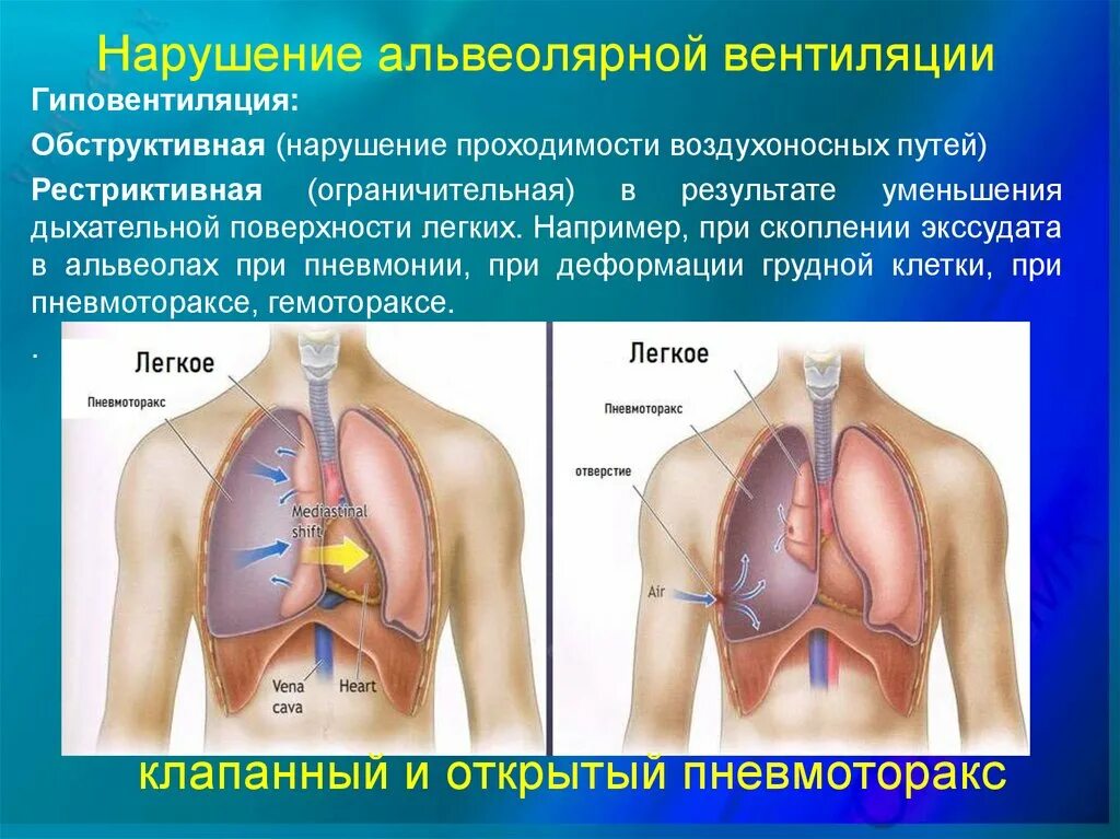 Дыхательная площадь легких. Патологии дыхательной системы. Нарушение альвиолярнойвентиляции. Нарушение альвеолярной вентиляции. Патология органов дыхания.