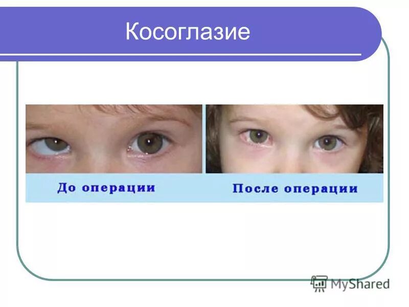 Непостоянное расходящееся косоглазие. Расходяшие косрюоглазия. Косоглазие. Небольшое косоглазие. Косоглазие.