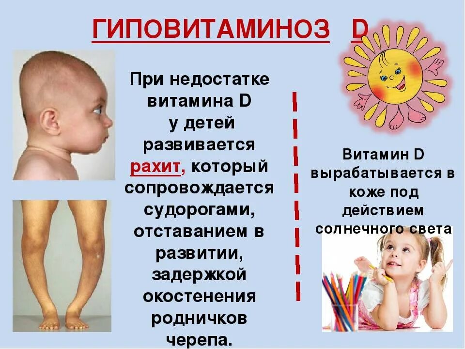 Признаки дефицитов у детей. Рахит при недостатке витамина д. Рахит у детей последствия дефицита витамина д. Недостаток витамина д дети рахит. Недостаток витамина д у детей симптомы.