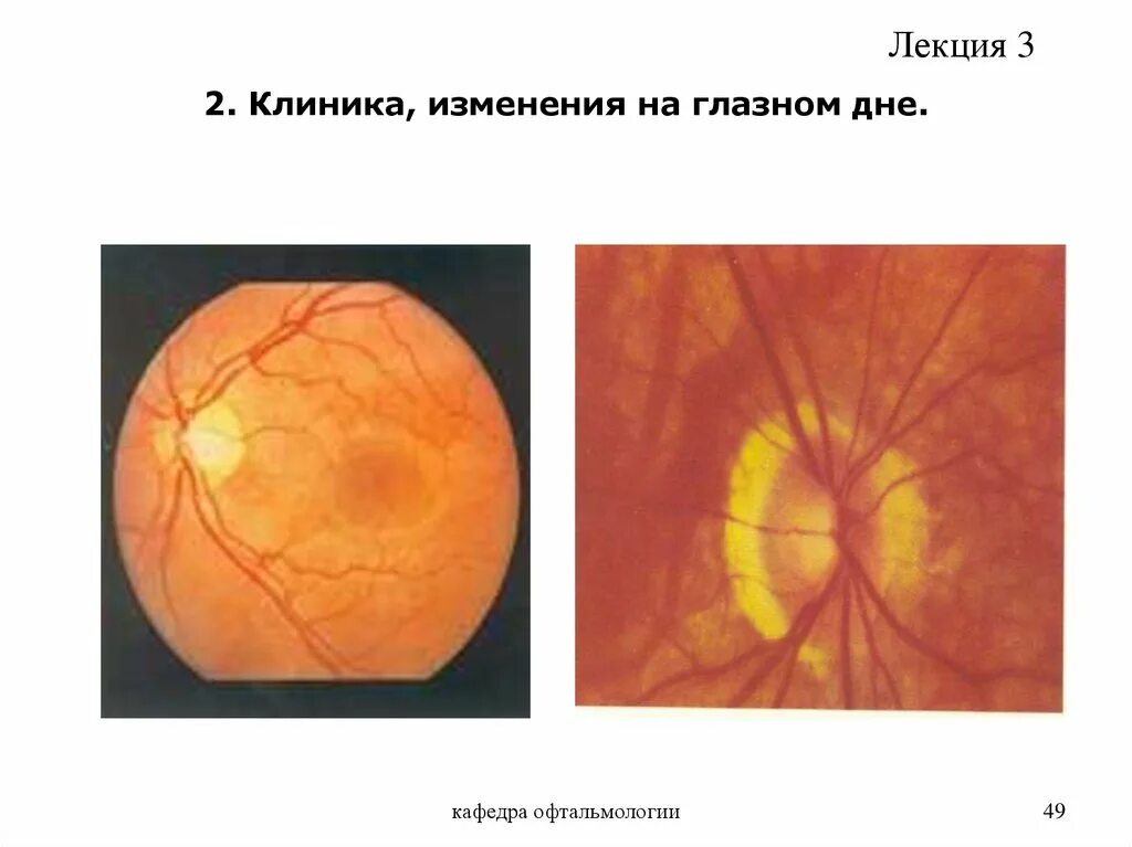 Изменения на глазном дне. Перипапиллярная атрофия хориоидеи. Схема глазного дна. Средство для исследования глазного дна.