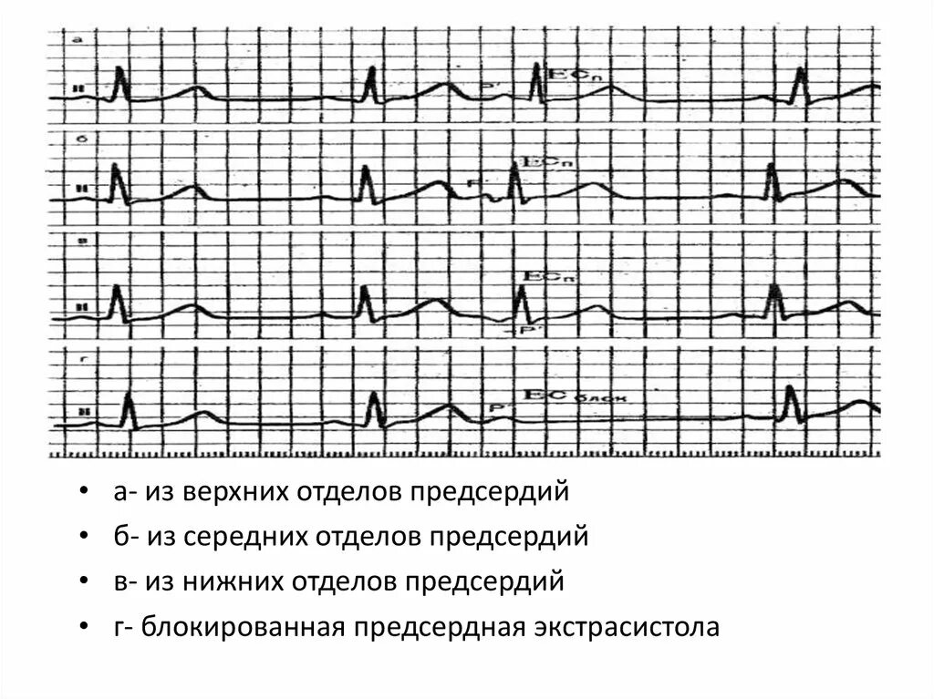 Блокированная желудочковая экстрасистолия. Блокированная экстрасистолия на ЭКГ. Блокированные желудочковые экстрасистолы на ЭКГ. Блокированная предсердная экстрасистолия на ЭКГ. Блокированные экстрасистолы