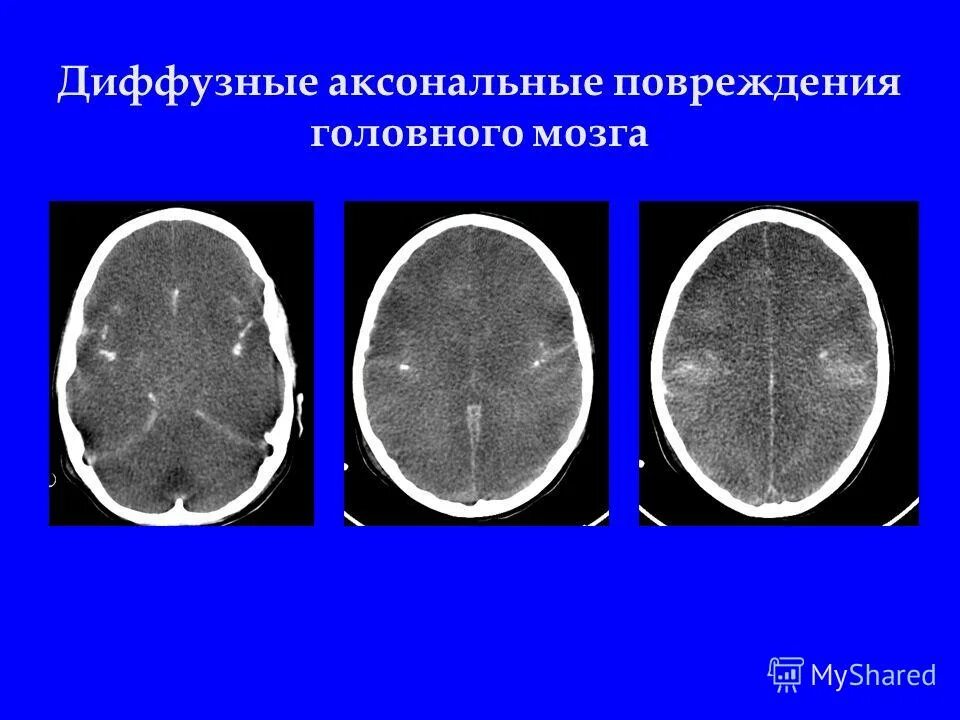 Диффузное аксональное повреждение дап головного мозга. Диффузное аксональное повреждение головного мозга причины. Диффузное аксональное повреждение головного мозга. Диффузное аксональное повреждение дап головного мозга. Диффузное аксональное повреждение головного мозга кт.