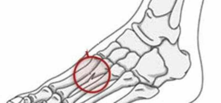 Сколько времени болят переломы. Перелом ладьевидной кости стопы рентген. Ладьевидная кубовидная кость стопы. Ладьевидная кость стопы рентген. Стрессовый перелом 5 плюсневой кости.