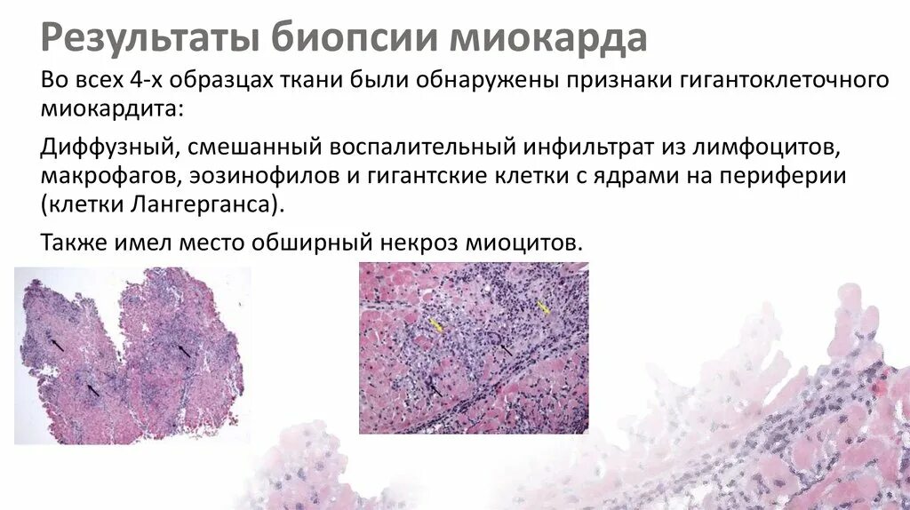 Результаты биопсии. Дерматомиозит биопсия. Дерматомиозит гистология. Гигантоклеточный злокачественный миокардит. Какие результаты биопсии