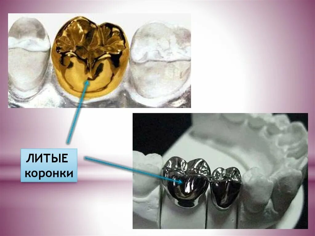 Штампованные коронки на зубы. Коронка цельнолитая (сплав remanium). Штампованные металлические коронки. Припасовка штампованных коронок. Литая металлическая коронка.