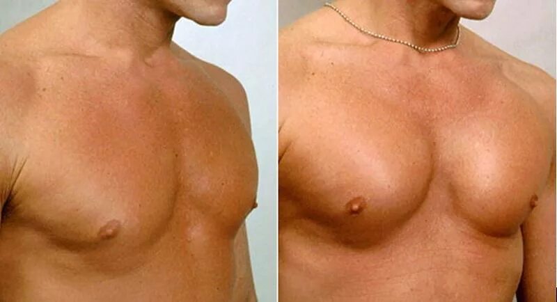 Гинекомастия грудных мышц. Кубики на прессе. Милованов гинекомастия. Гинекомастия стероиды. Пролактиновая гинекомастия.