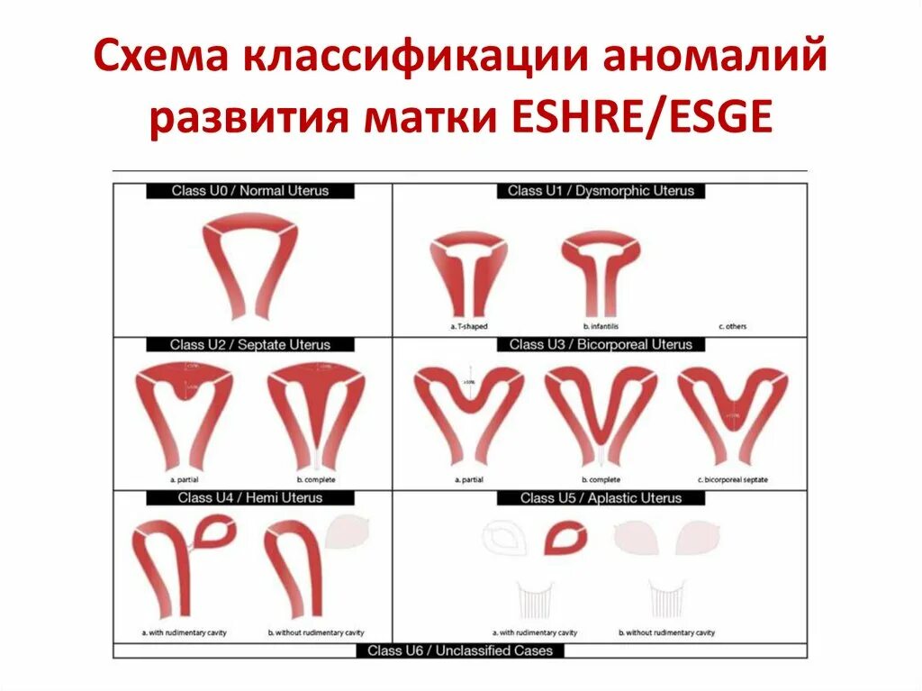 Аномалии развития и положения женских половых органов. Классификация аномалий развития матки ESHRE. ESHRE классификация пороков матки. Пороки развития матки классификация. Пороки развития матки и влагалища.