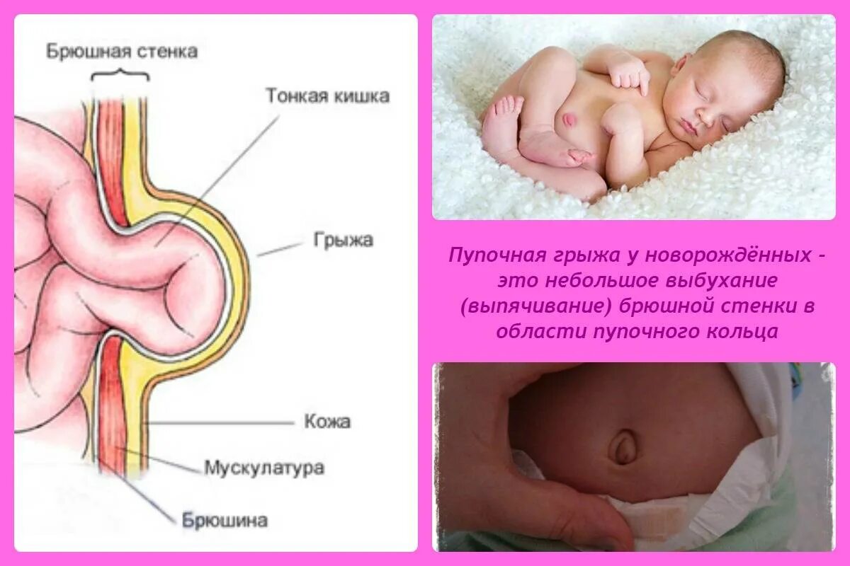 Пупок новорожденного пупочная грыжа. Пупковая грыжа у новорожденных. Пупочная грыжа умдетей. Пупочная грыжа у новорожд.