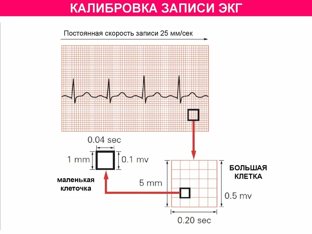 Мв на экг. Скорость 50 мм/с ЭКГ клеточки. Скорость записи ЭКГ 50 мм с. Размер клетки на ЭКГ. ЭКГ 25 мм 1 клетка 0,2 сек.