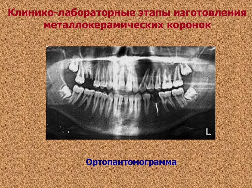 Клинико-лабораторные этапы изготовления металлокерамических. Клинико-лабораторные этапы изготовления коронок. Клинико лабораторные этапы металлокерамической коронки. Клинико лабораторные этапы изготовления металлокерамики. Лабораторные этапы металлокерамической коронки