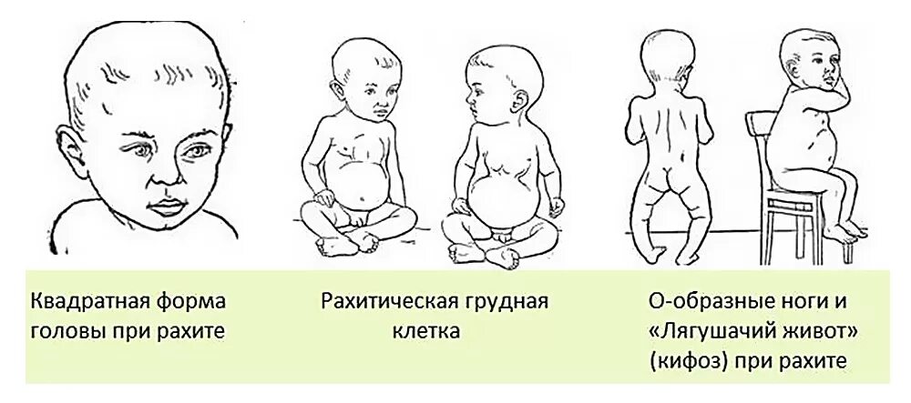 Витамин д дефицитный рахит у детей. Рахит 1 степени симптомы у новорожденных. Нехватка витамина д симптомы рахит. Рахит симптомы у детей 1 год. Разит значение