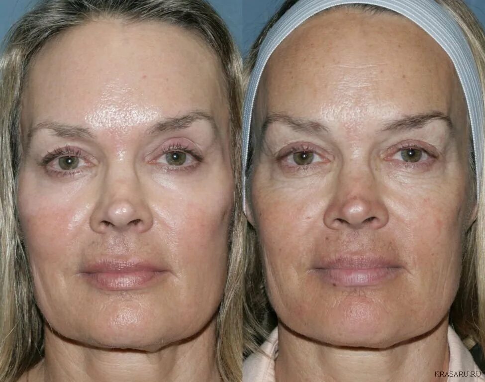 Лазерная шлифовка кожи цена skinlift ru. Лазерный пилинг фраксель. Фракционный фототермолиз со2. Фракционный лазерный термолиз со2. Лазерный пилинг для лица от морщин.