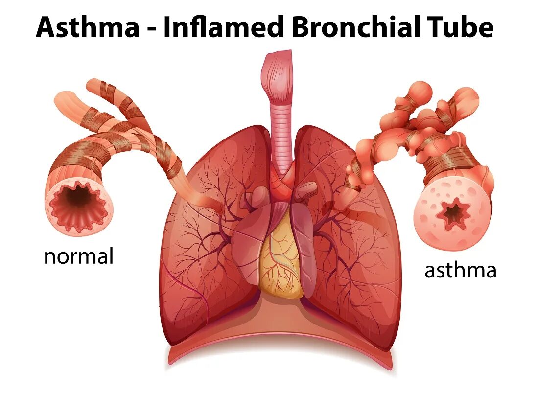 Bronchial asthma. Бронхиальная астма.