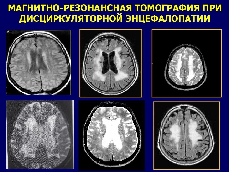 Признаки дисциркуляторных изменений. Энцефалопатия головного мозга на кт. Кт картина дисциркуляторная энцефалопатия. Дисциркуляторная энцефалопатия на кт на кт. Лейкоэнцефалопатия головного мозга кт.