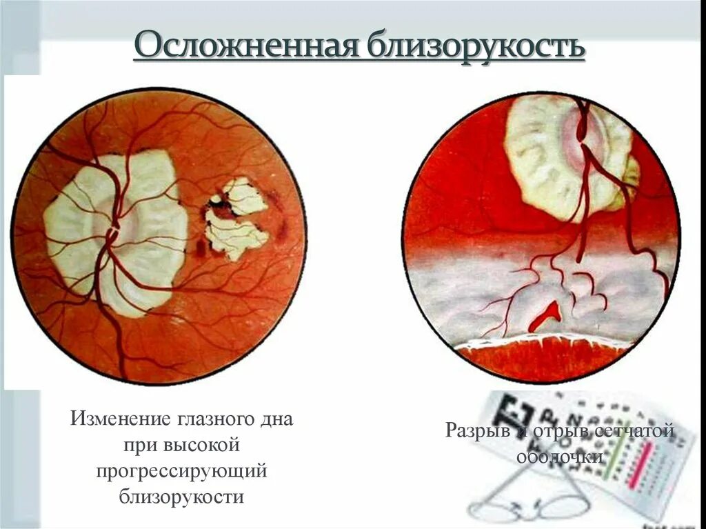 Миопический конус глазное дно. Прогрессирующая близорукость осложнения. Изменение на глазном дне