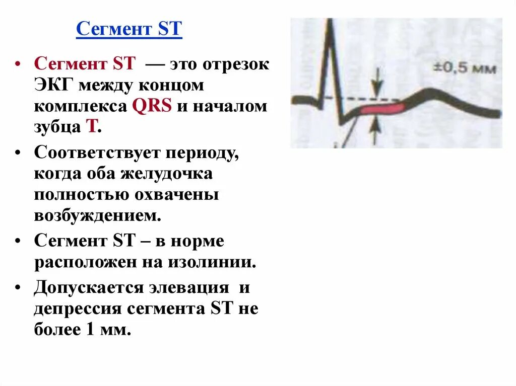 Элевация сегмента st на экг. Элевация и депрессия сегмента st на экг. Сегмент st на экг. Элевация st на экг. Экг норма интервалы ст.