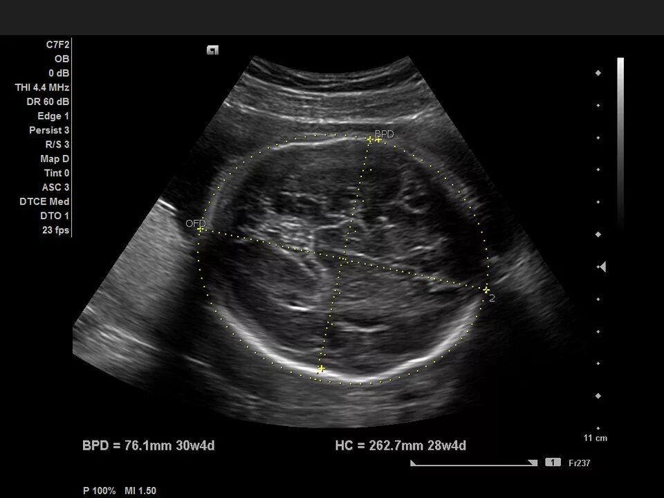 Узи дема. Измерение БПР на УЗИ. Бипариетальный размер головки плода по УЗИ. БПР УЗИ беременность. Ультразвуковое исследование при беременности-БПР.