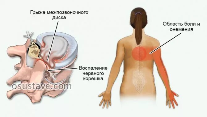 Остеохондроз симптомы ощущение у женщин. Боли при грудном остеохондрозе. локализация боли при остеохондрозе грудного отдела. локализация боли при грудном остеохондрозе. остеохондроз грудного отдела симптомы у женщин.