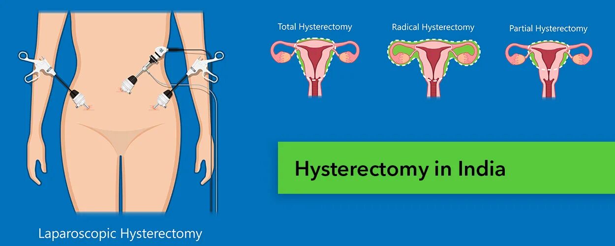 Гистерэктомия что это такое простыми. Расширенная гистерэктомия. Радикальная гистерэктомия. Радикальная гистерэктомия Тип а. Надвлагалищная ампутация матки.