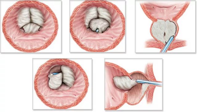 Как убрать простату. Лазерная энуклеация предстательной железы. Трансуретральная лазерная энуклеация аденомы предстательной железы. Лазерная энуклеация гиперплазии простаты. Операция лазерная энуклеация аденомы простаты.