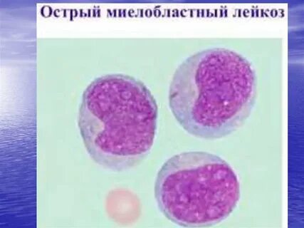 Острый моноцитарный лейкоз