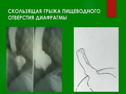 Грыжа пищевода узи