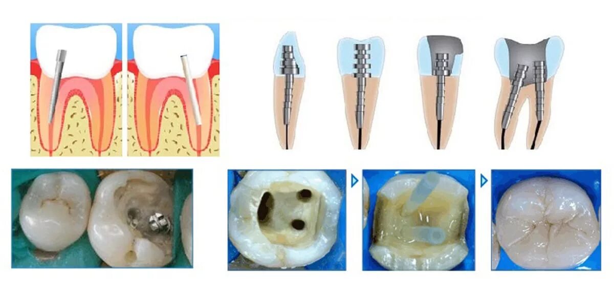 Почему открывают зуб. Стекловолоконный штифт с пломбой. Анкерный и стекловолоконный штифт. Пломбировка каналов зуба штифтами.