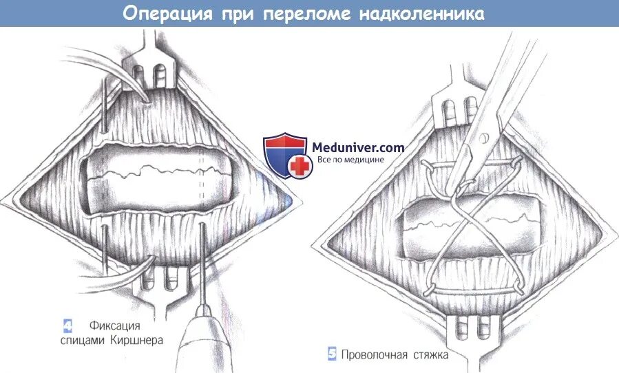 Операции при переломе надколенника по Веберу. Перелом надколенника и остеосинтез по Веберу. Кисетный шов перелома надколенника. Операция Вебера при переломе надколенника. Перелом надколенника операции