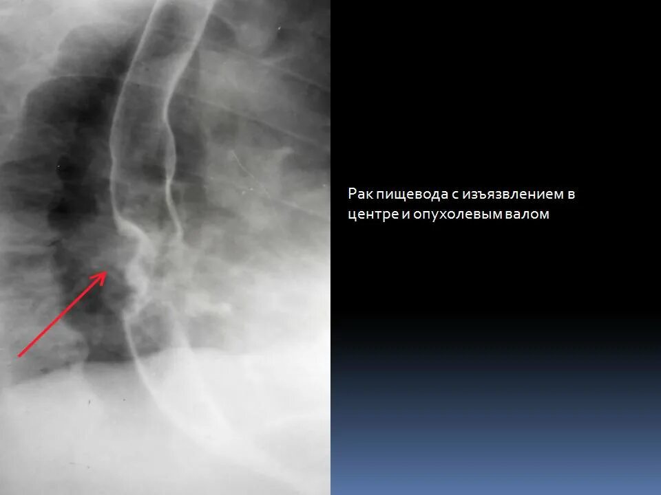 Код пищевода. Доброкачественные опухоли пищевода. Доброкачественная опухоль пищевода рентген. Огромная опухоль пищевода рентген.