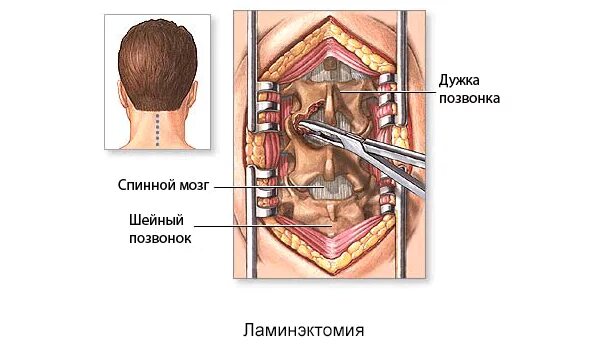 Операция на шейном отделе. Операция шейного отдела позвоночника. Операция на шейных позвонках. Операция на шейном отделе позвоночника. Шейная грыжа операция отзывы