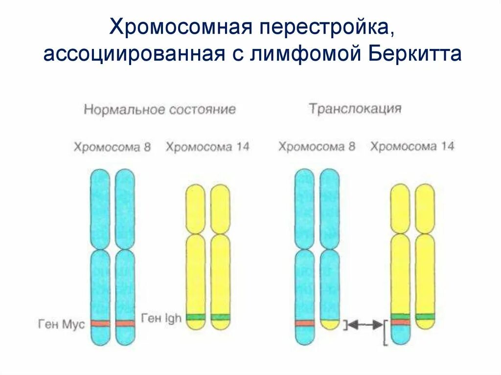 2 хромосома нарушения. Беркитта транслокация. Транслокация Робертсона. Лимфома Беркитта транслокация. Хромосомная транслокация.