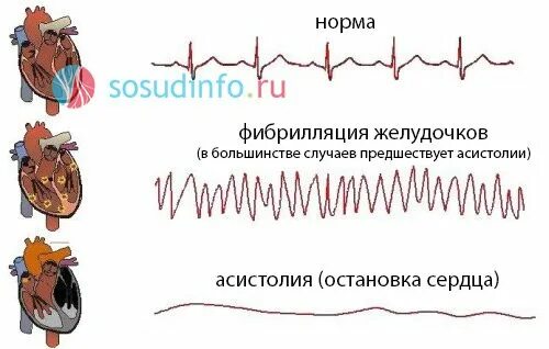 Останавливается сердце форум