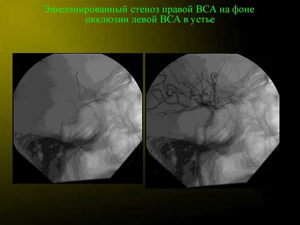 Стеноз устья вса. Стеноз внутренней сонной артерии.