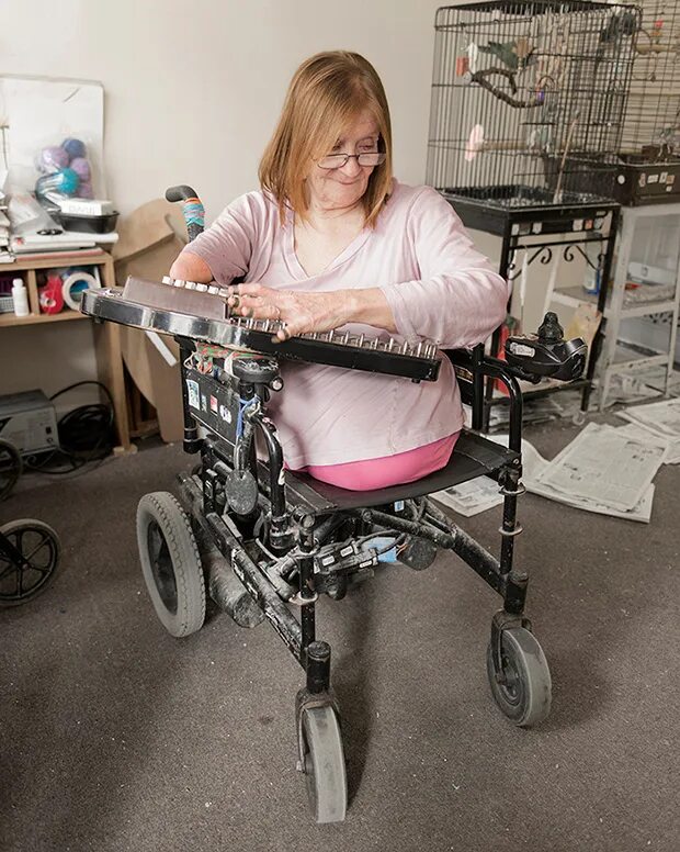 Родилась без ноги. Женщина инвалид. Люди с редкими заболеваниями. Женщины инвалиды без ног и рук.