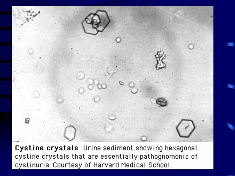 Повышен цистин в моче. Цистин в моче микроскопия. Цистин Кристаллы в моче. Кристаллы цистина микроскопия. Кристаллы цистина в моче микроскопия.