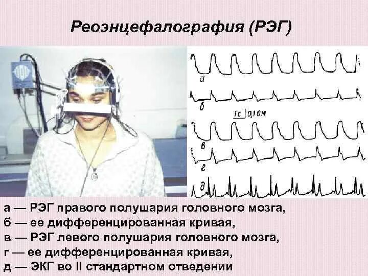 Доктор ээг. Реоэнцефалография сосудов головного мозга норма. РЭГ наложение электродов. Реоэнцефалография метод исследования. РЭГ сосудов головного мозга методика.