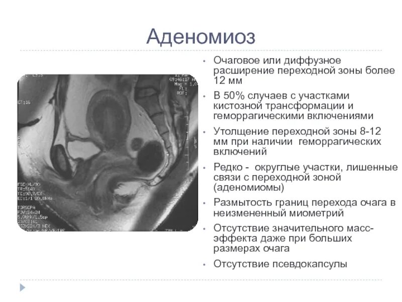 Очаговая форма аденомиоза мрт. Аденомиоз диффузная форма. Диффузная форма аденомиоза на УЗИ. Очаговый аденомиоз матки мрт.