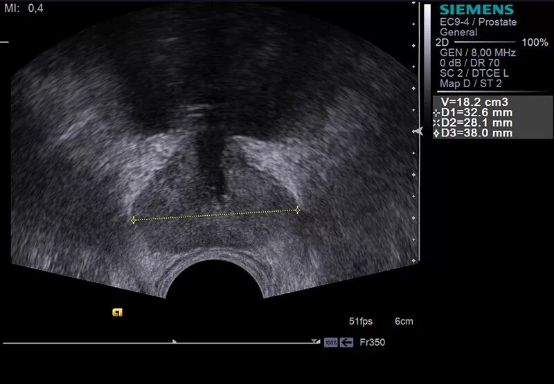 Дгпж узи. Гиперплазия предстательной железы УЗИ. Трансректальное УЗИ предстательной железы. Трансректальное УЗИ предстательной железы (+УЗИ мочевого пузыря. УЗИ предстательной железы на УЗИ.