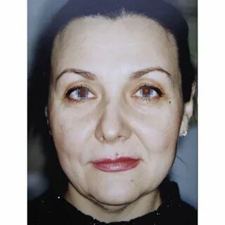 Клиник лифтинг