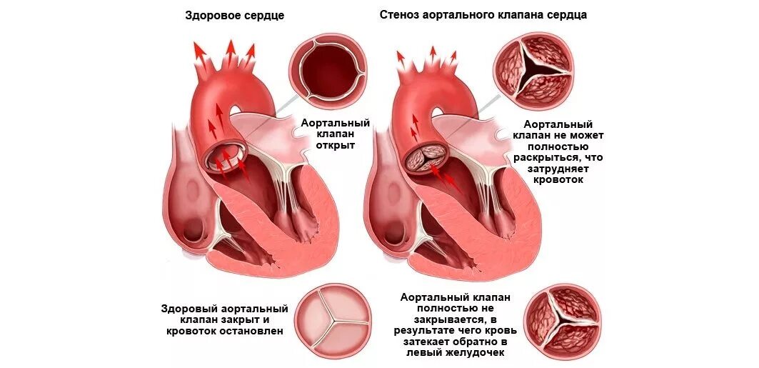 Стеноз аортального клапана. Митральный клапан и аортальный клапан. Порок аортального клапана сердца. Стеноз двустворчатого аортального клапана.