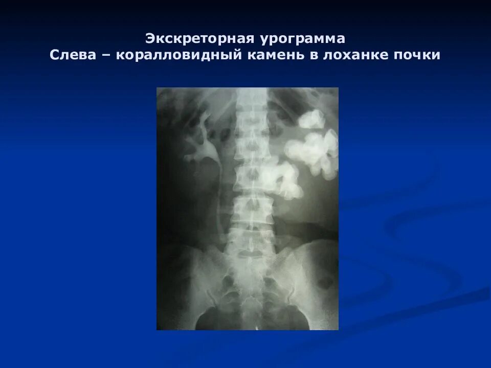 Коралловидный камень левой почки. Коралловидный камень в почке. Камень в лоханке левой почки. Коралловидный камень в почке в лоханке.