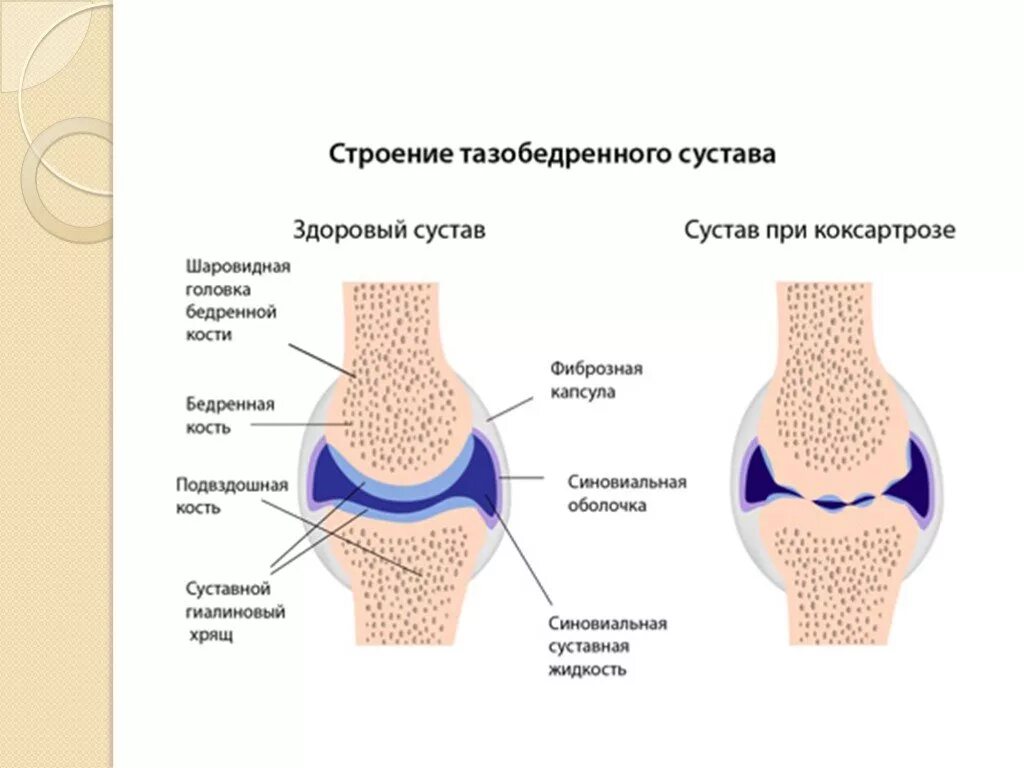 Какие бывают болезни суставов. Синовиальная жидкость в тазобедренном суставе. Синовиальная оболочка тазобедренного сустава.