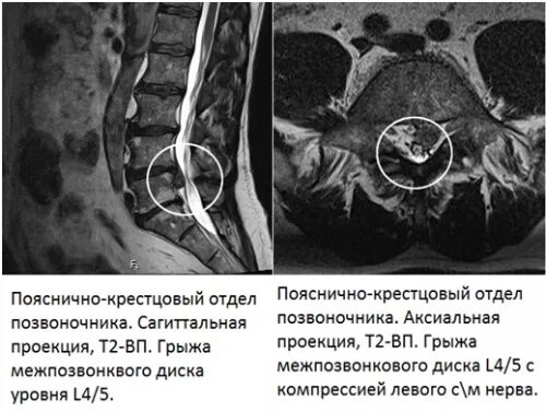 Болит поясница киста. Мрт снимок пояснично-крестцового отдела. Мрт позвонка поясничного отдела. Грыжа позвоночника поясничного отдела на кт. Мрт позвоночника расшифровка снимков.