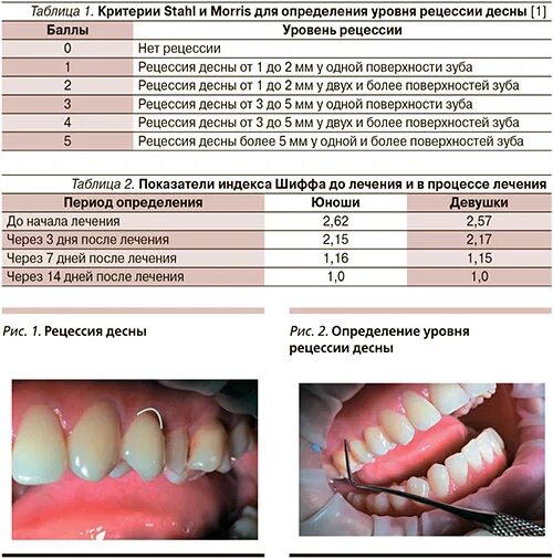 Индекс десна. Клиновидный дефект на зубах у десны. Рецессии десны рецессия классификация. Классификация рецессии десны по Миллеру. Рецессия в стоматологии.
